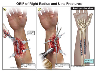 ORIF of Right Radius and Ulna Fractures