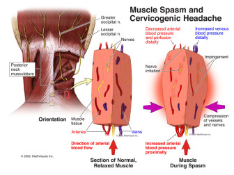 Muscle Spasm and Cervicogenic Headache