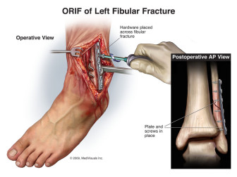 ORIF of Left Ankle Fracture