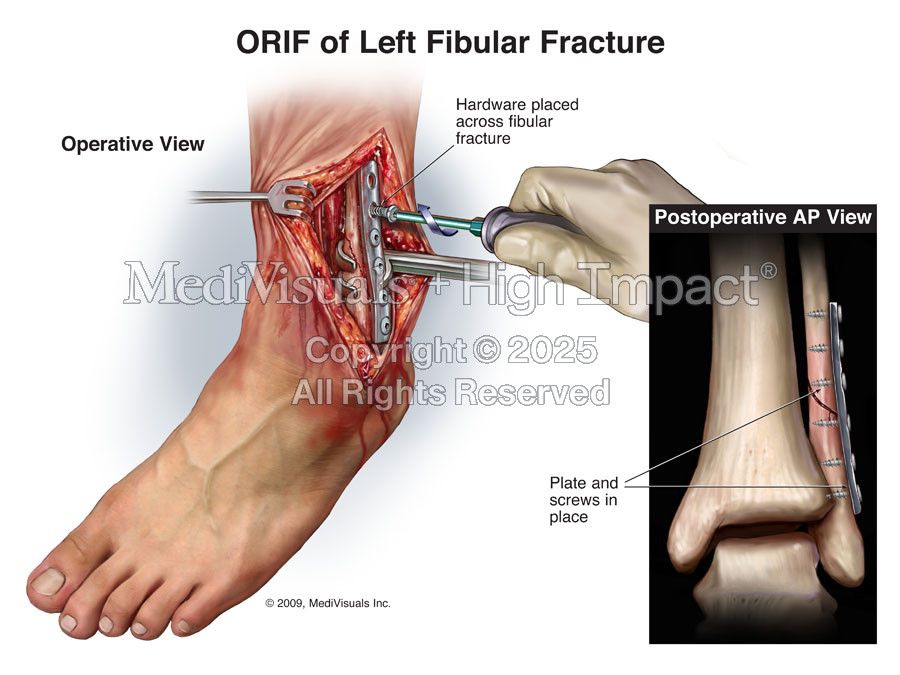 ORIF of Left Ankle Fracture