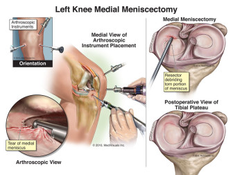 Left Knee Medial Meniscectomy