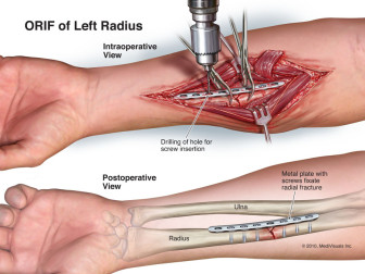 Left Forearm ORIF Surgery