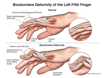 Boutonniere Deformity of the Left Fifth Finger