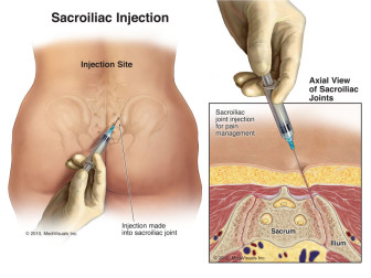 Sacroiliac Injection (SI Joint)