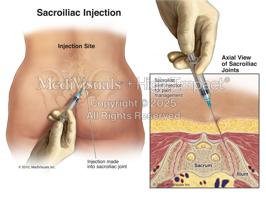 Sacroiliac Injection (SI Joint)