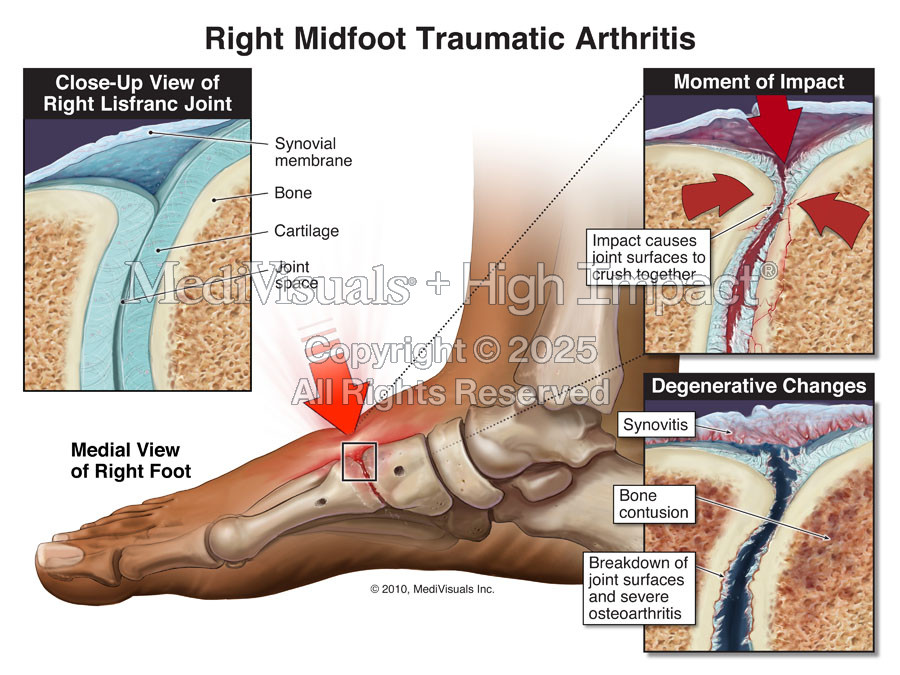 Exacerbation of Midfoot Degenerative Changes