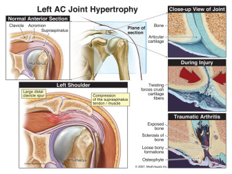 Left AC Joint Hypertrophy (Post-Traumatic Arthritis) Resulting in Subacromial Impingement