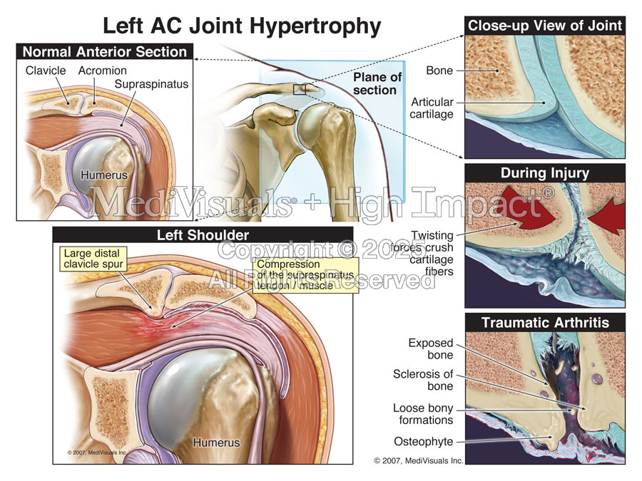 Left AC Joint Hypertrophy (Post-Traumatic Arthritis) Resulting in Subacromial Impingement