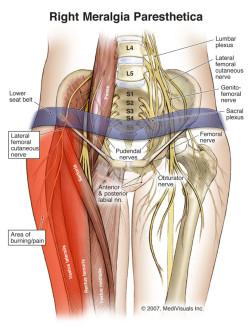 Right Meralgia Paresthetica