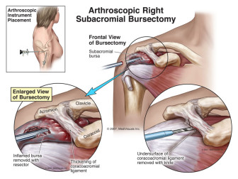 Arthroscopic Right Subacromial Bursectomy and Decompression