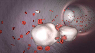 Administration of Calcium Phosphate (CaP) Bone Cement into Blood Stream