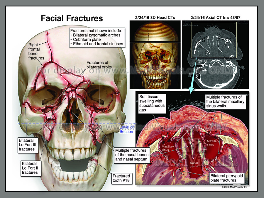$8M Settlement: Motorcyclist Suffers Severe Facial Injuries and Brain Trauma