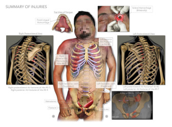 Rib Fractures and Hemorrhages