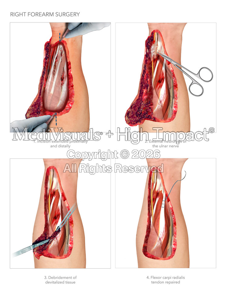 $18M Verdict: Illustrating Severe Injuries and Surgeries Following Fall in Parking Lot