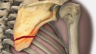 Confidential Settlement: Trucking Passenger Injured in Rollover Collision