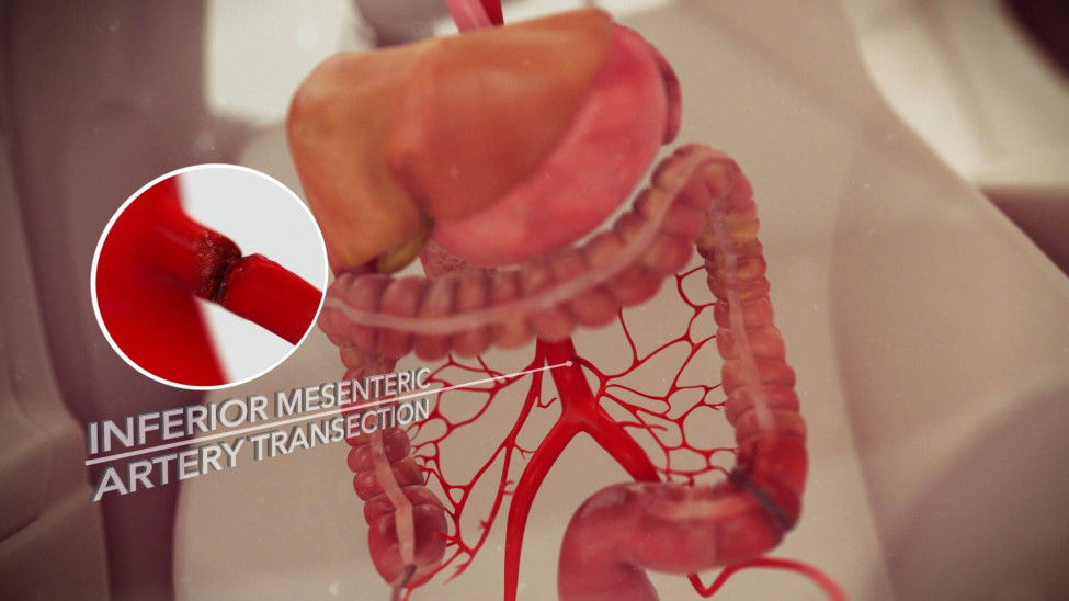 3D Animated ‘Moment in Time’ Shows Seat Belt Injury