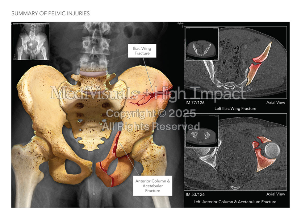 $1.75M Verdict: Colorized Films Highlight Motorcycle Injuries