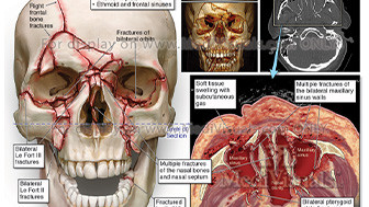 $8M Settlement: Motorcyclist Suffers Severe Facial Injuries and Brain Trauma