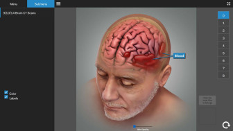 Summary of Brain Injuries