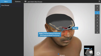 Frontal Bone & Facial Injuries