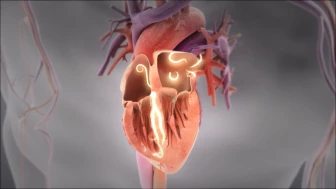 Atrial Fibrillation