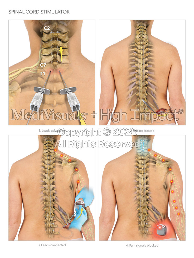 $18M Verdict: Illustrating Severe Injuries and Surgeries Following Fall in Parking Lot