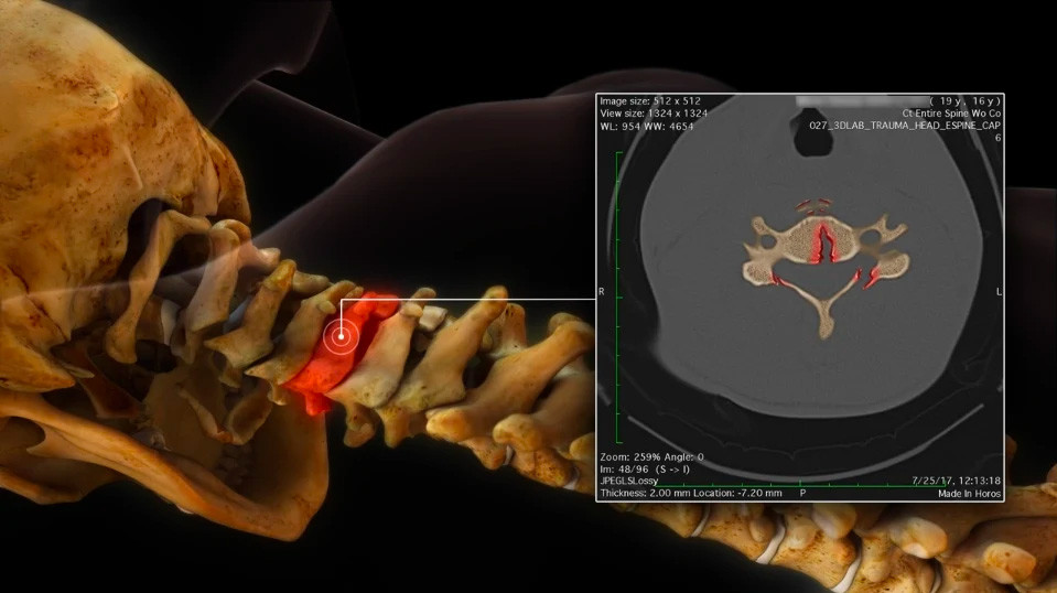 $10M Verdict: Animations Show Extent of Injury From Football Incident
