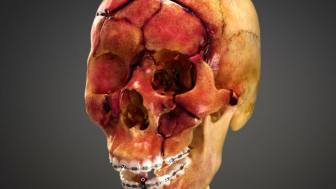 Skull Fracture Animation