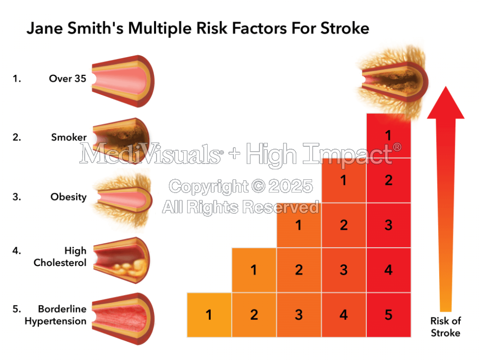Stroke Risk Factors