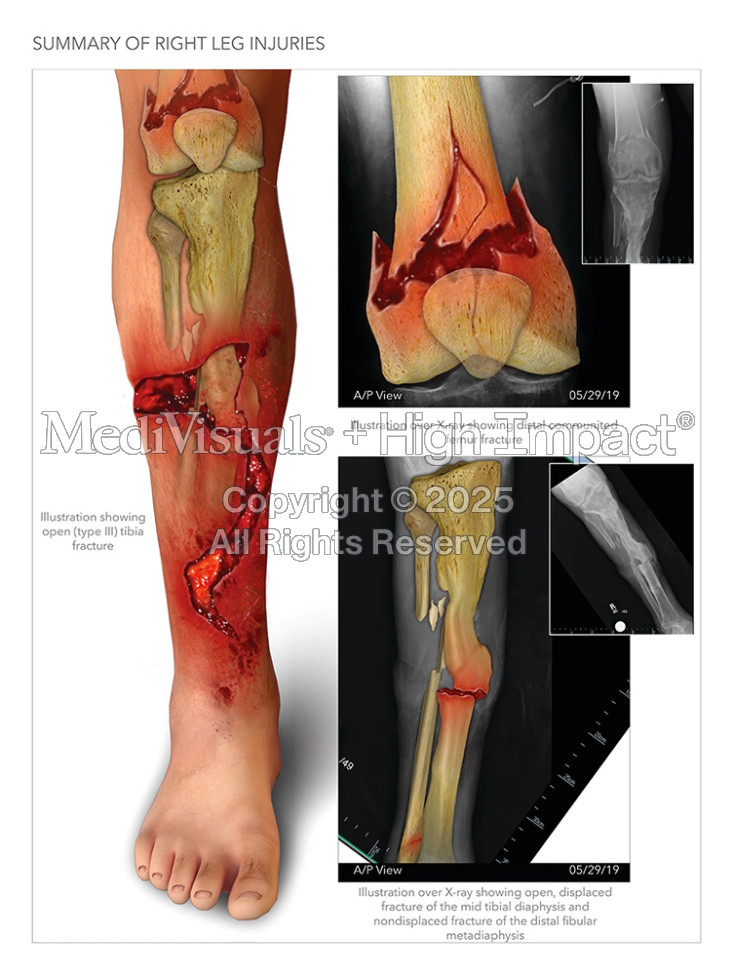 $1.15M Settlement: Illustrating Leg Fractures After Car Hits Man on Scooter