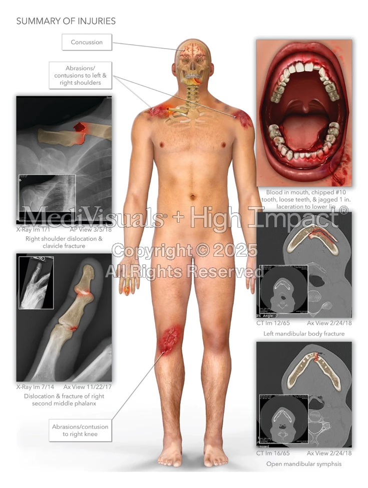 $1M Settlement: Illustrating Fractured Jaw After Cyclist Hit by Truck