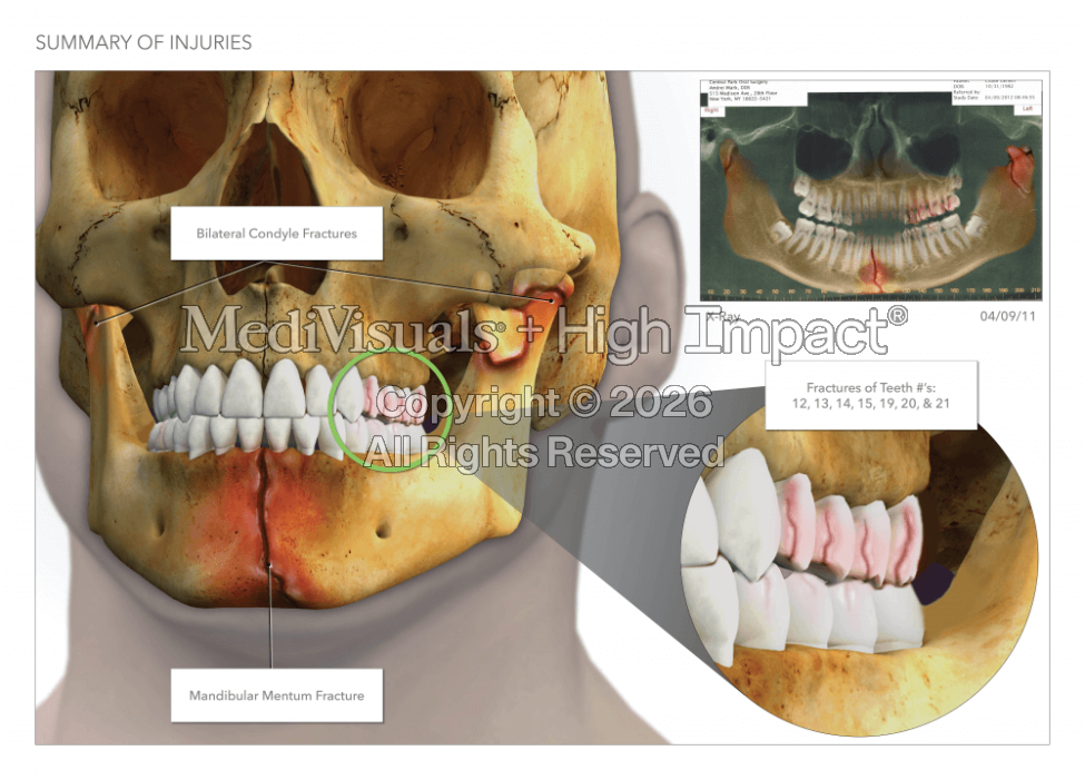 Mandibular Fractures