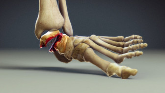 $2.4M Verdict: Animated Ankle Crushed by Vehicle Results in Complex Regional Pain Syndrome (CRPS)