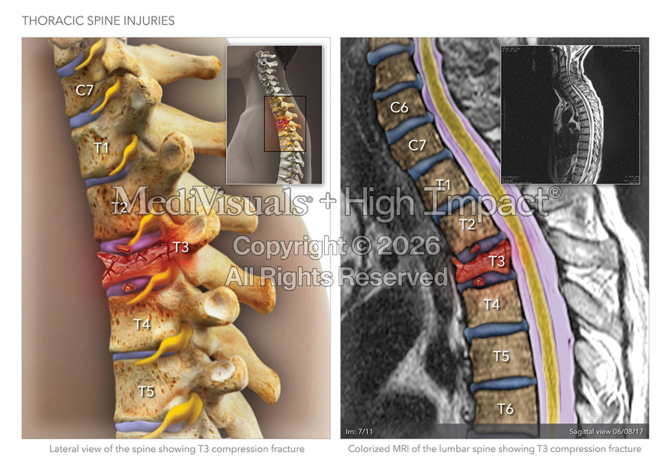 The Best Ways to Show Your Client’s Spine Injury and Maximize Your Results