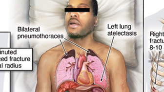 $37.5 Million Confidential Settlement: Plaintiff Rear-ended Stopped Tractor-Trailer