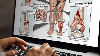 $3.5M Verdict: Traumatic Leg Injuries Following Motor Vehicle Collision