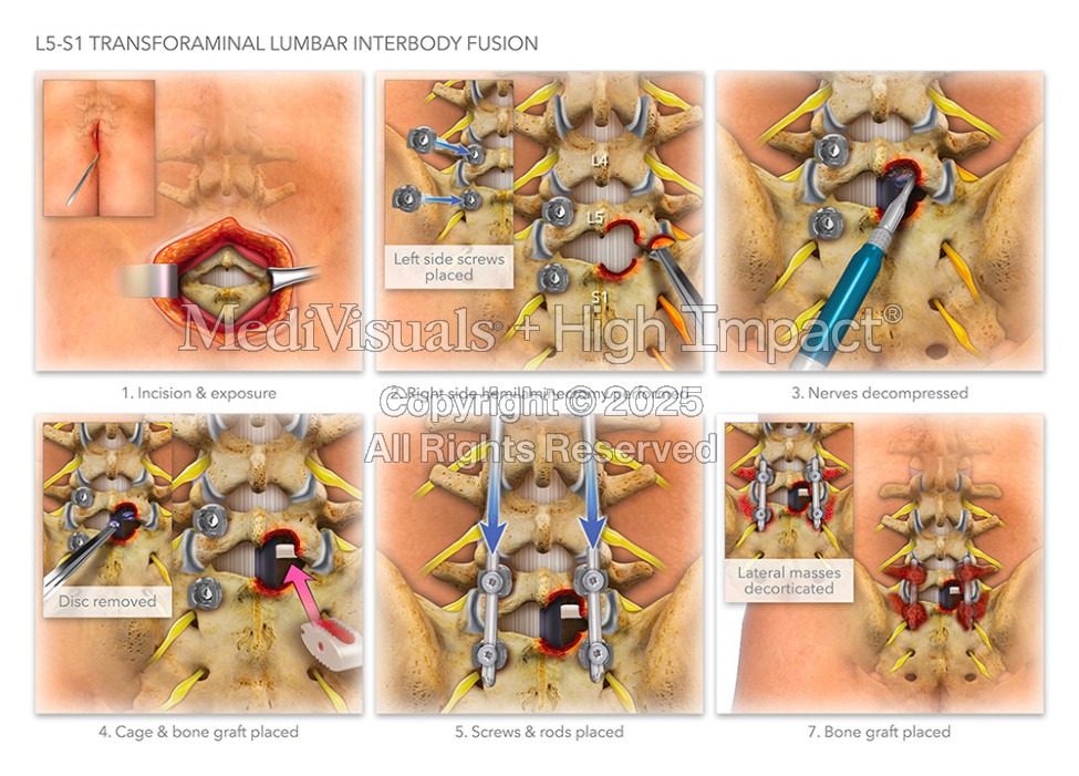 $3.6M Jury Verdict: Illustrating Spine Injuries After Man Hit by Golf Cart