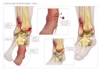 Open Reduction Internal Fixation of the Right Ankle