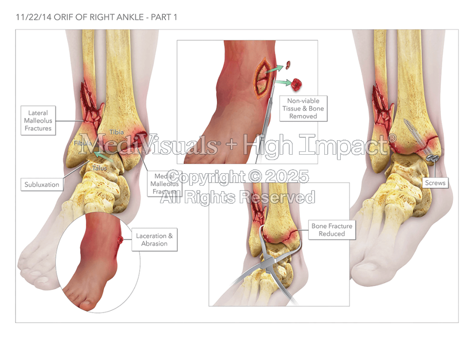 Open Reduction Internal Fixation of the Right Ankle