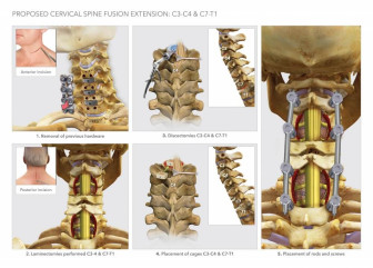Proposed Cervical Spine Fusion Extension