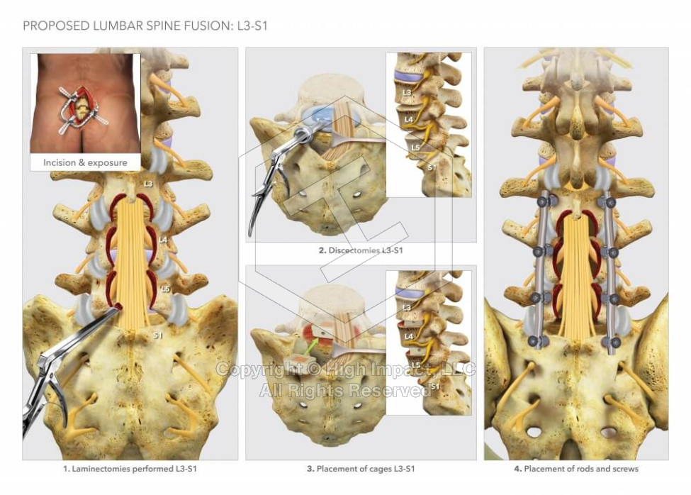 Proposed Lumbar Spine Fusion