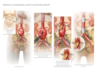 Removal of Abdominal Aortic Aneurysm