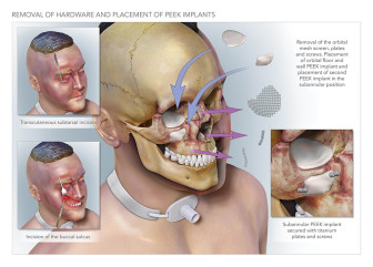 Removal of Hardware and Placement of PEEK Implants