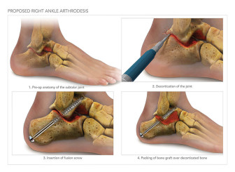 Repair of Foot & Ankle Injuries