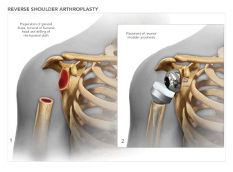 Reverse Shoulder Arthroplasty