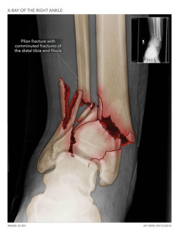 Right Ankle Fracture