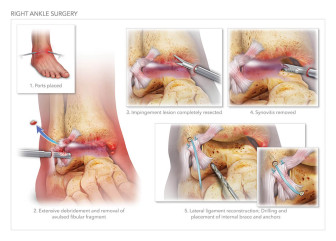 Right Ankle Surgery