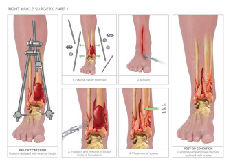 Right Ankle Surgery