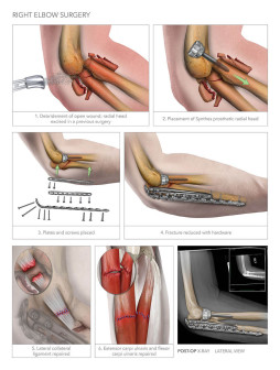 Right Elbow Surgery