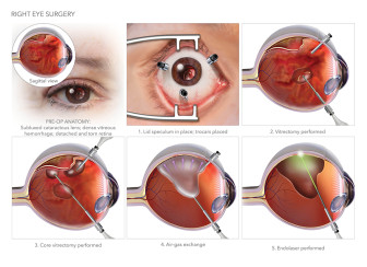 Right Eye Surgery